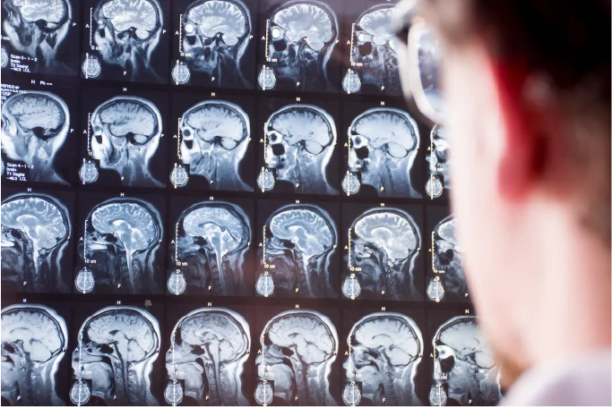 How Concussions Affect Women in Accidents: Recovery & Legal Rights