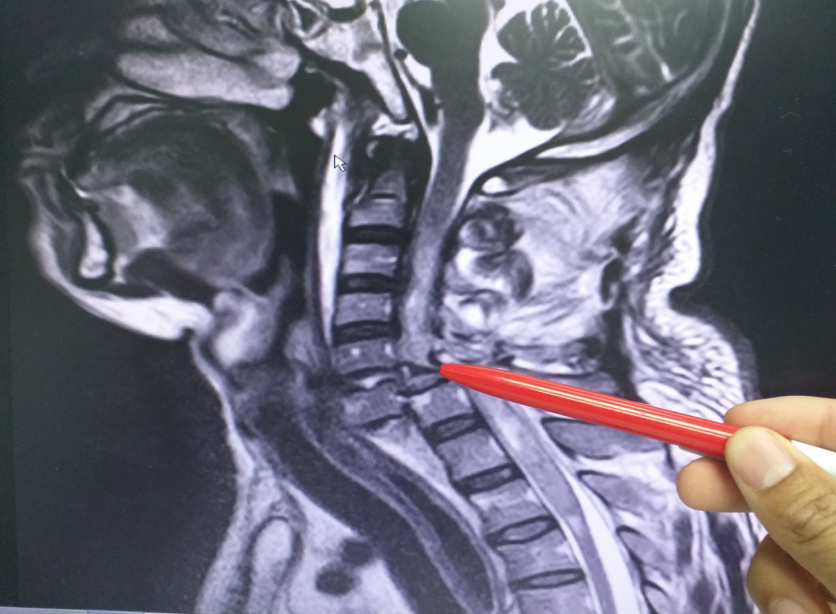 Neck injury after a car wreck