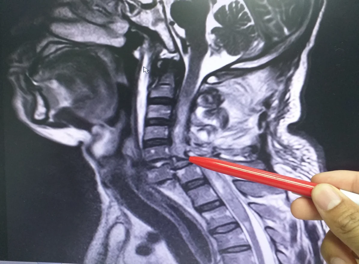 Neck injury after a car wreck